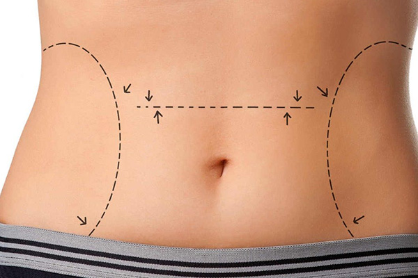 abdominoplastia